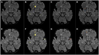 Two Time Point MS Lesion Segmentation in Brain MRI: An Expectation-Maximization Framework